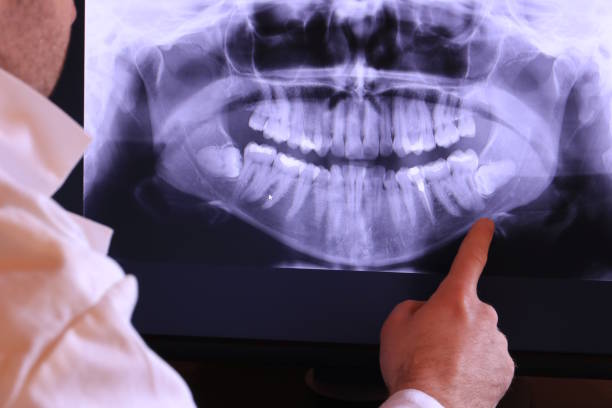Best Emergency Wisdom Teeth Removal in Stowell, TX