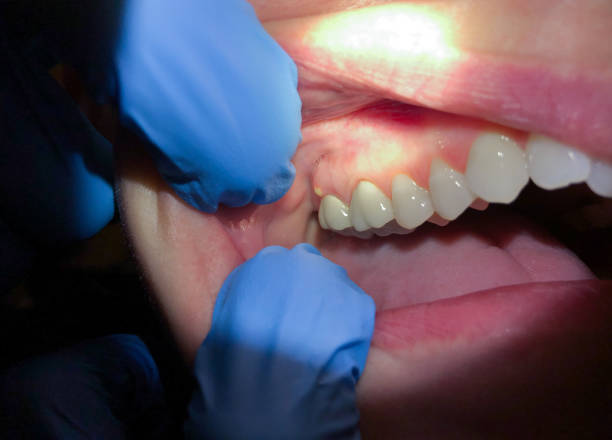 Best Emergency Treatment for Toothache in Stowell, TX
